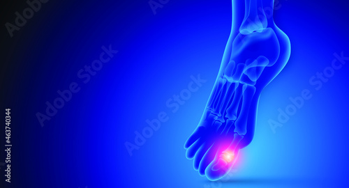 Illustration of Arthritis ankle joint . Rheumatoid arthritis.  Human bone anatomy flat vector illustration on a blue technology background. 3d rendered medically accurate illustration.