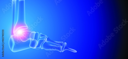 Illustration of Arthritis ankle joint . Rheumatoid arthritis.  Human bone anatomy flat vector illustration on a blue technology background. 3d rendered medically accurate illustration.