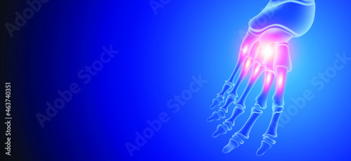 Illustration of Arthritis ankle joint . Rheumatoid arthritis.  Human bone anatomy flat vector illustration on a blue technology background. 3d rendered medically accurate illustration.