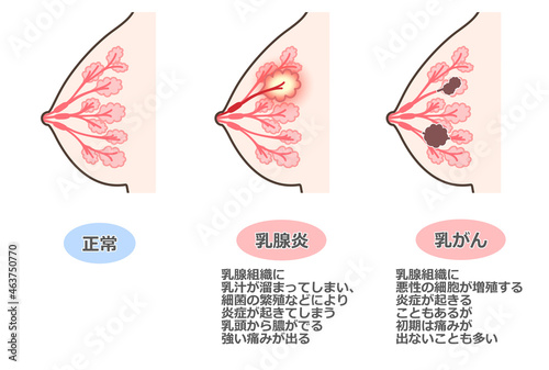 胸の病気のイラスト