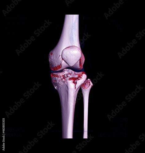 CT knee joint 3D rendering image  showing fracture tibia bone