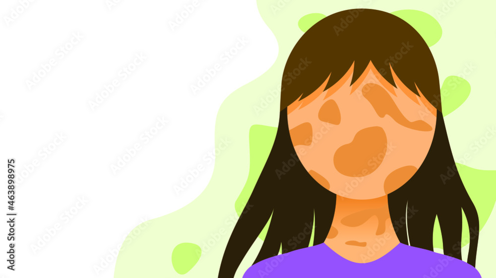 Flat Girl Woman Character With Spots Vitiligo Depigmentation Disease Vector Design Style Concept People Are Equal Flat Girl Woman Character With Spots Vitiligo Depigmentation Disease Vector Design Style Concept People Are Equal
