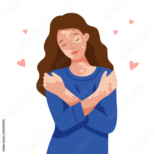 Happy girl with vitiligo hugs herself by the shoulders. World vitiligo day. A woman loves her body. Self care. 