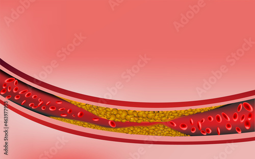 clogged arteries. Illustration of an Artery blocked with cholestero. Clogged arteries with fatty deposits are the leading cause of death.