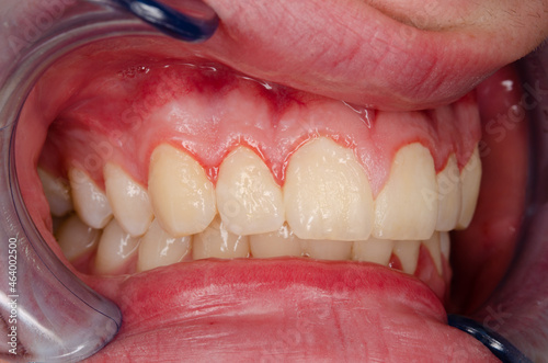 gingivitis and dental plaque, upper right front photo