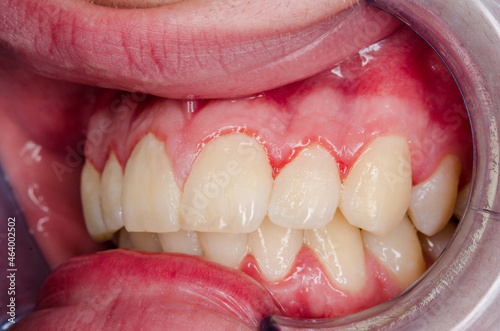 gingivitis and dental plaque, upper left front