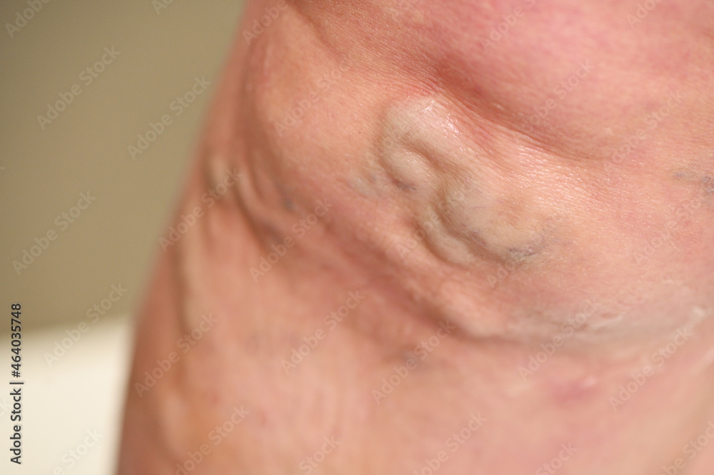 Naklejka premium varicose veins close-up on the patient's leg. Prevention of thrombosis