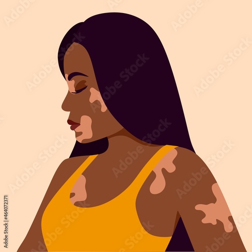 Vitiligo is a young dark-skinned woman with skin problems. Skin diseases. The concept of World Vitiligo Day. Different skin colors of female characters. For a blog, articles, banner, magazine. 