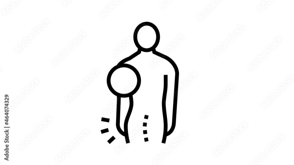 idiopathic scoliosis animated line icon. idiopathic scoliosis sign ...