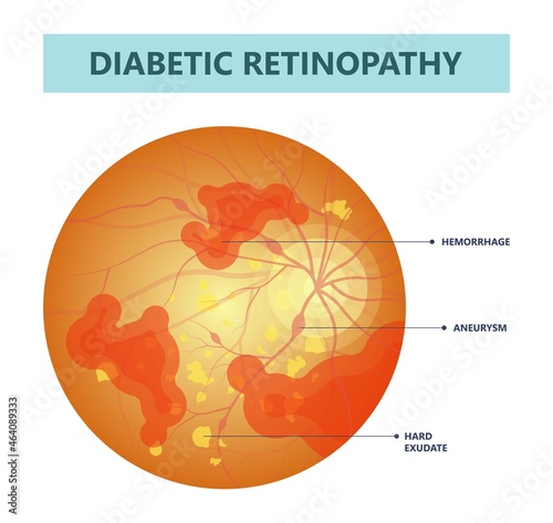 Diabetic retinopathy fundus age eye blood vessels vision Blurred loss exam pregnant retinal macula Blurry laser surgery