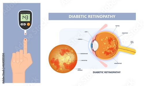 Diabetic retinopathy fundus age eye blood vessels vision Blurred loss exam pregnant retinal macula Blurry laser surgery photo