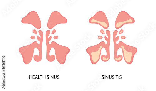 Healthy sinus and sinusitis flat image. Infection, inflammation, nasal diseases. Can be used for topics like health, diagnosis, anatomy photo