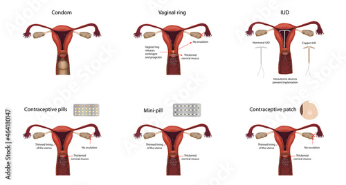 Contraception methods. IUD, contraceptive patch, pills, mini-pill, condom, vaginal ring. Vector medical illustration.