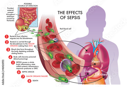 Medical illustration of effects of sepsis. photo