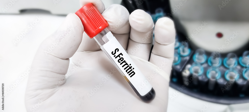 Test tube with blood sample for serum ferritin test Stock Photo - Adobe Stock