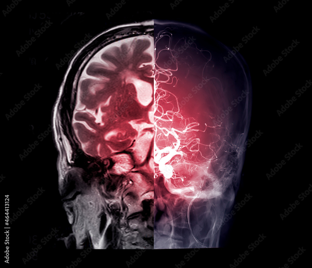 Compare MRI brain coronal view Cerebral angiography image front view