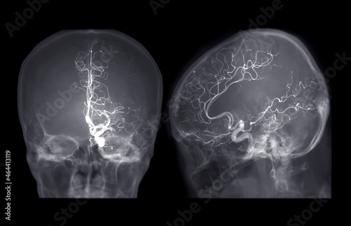 Cerebral angiography AP and Lateral view image from Fluoroscopy in intervention radiology showing cerebral artery.