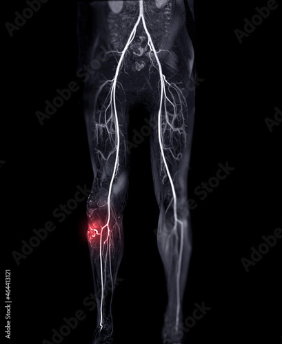 Fotografie Magnetic resonance angiography of peripheral runoff vessels showing Arteriovenous malformation