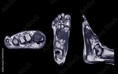 Bild auf Leinwand Manetic resonance imaging of foot or MRI FOOT PDW axial, Coronal and sagittal view for diagnostic tendon injury