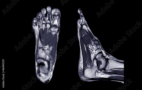 Foto Manetic resonance imaging of foot or MRI FOOT PDW axial, Coronal and sagittal view for diagnostic tendon injury
