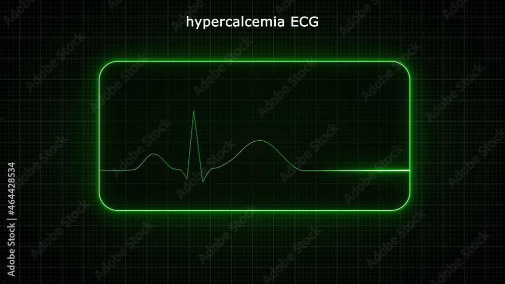 The main ECG abnormality seen with hypercalcaemia is shortening of the