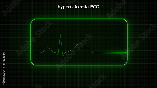  The main ECG abnormality seen with hypercalcaemia is shortening of the QT interval · photo