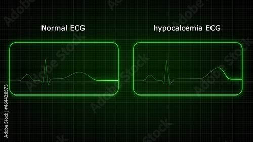 The ECG hallmark of hypocalcemia remains the prolongation of the QTcinterval because of lengthening of the ST segment. photo