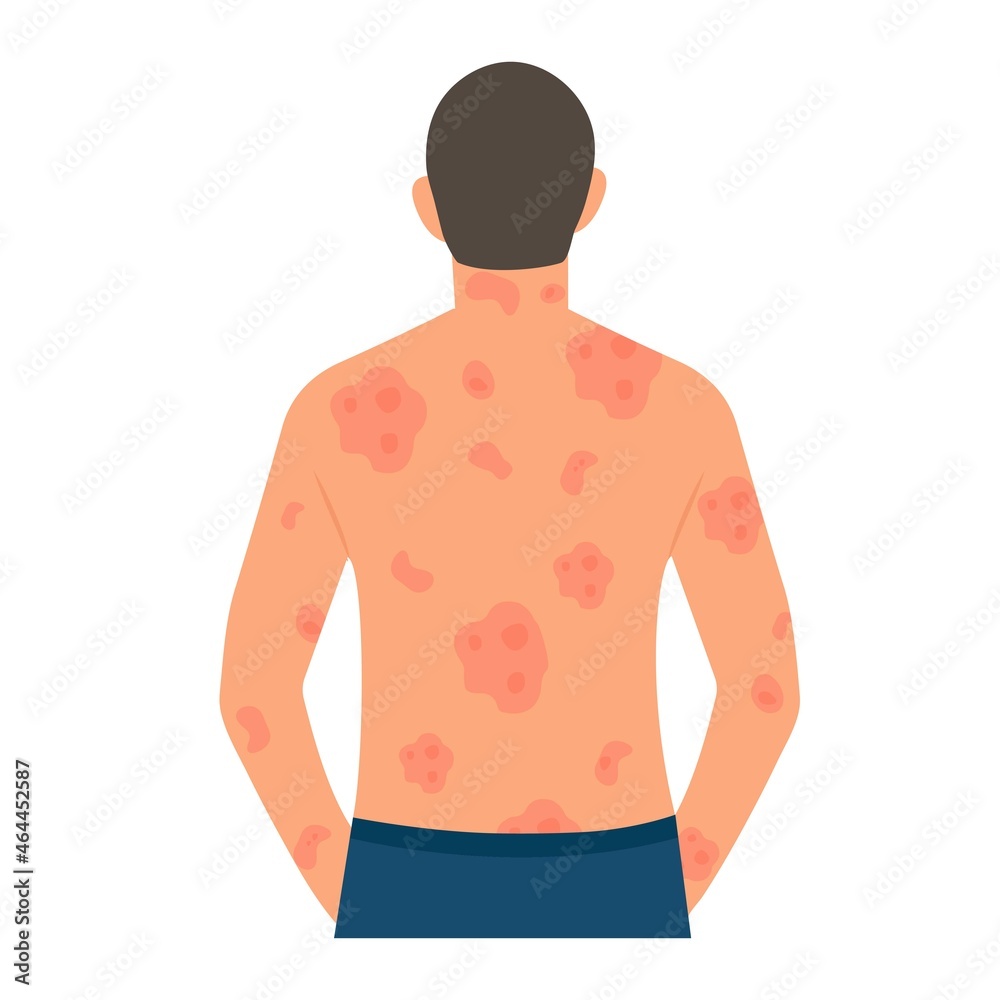 Fototapeta premium Dermatological skin disease, psoriasis.Allergic itching, skin inflammation, redness and irritation.Guttate psoriasis.Skin problems.isolated, vector.
