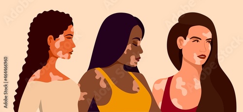 Vitiligo three young women of different races with skin problems. Skin diseases. The concept of World Vitiligo Day. Different skin colors of female characters. For a blog, articles, banner, magazine. 