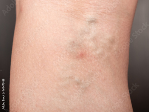 woman with varicose legs, thrombosis of distended veins