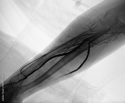 The preoperative evaluation consisted of angiogram of the radial artery. The angiogram showed radial artery stenosis
