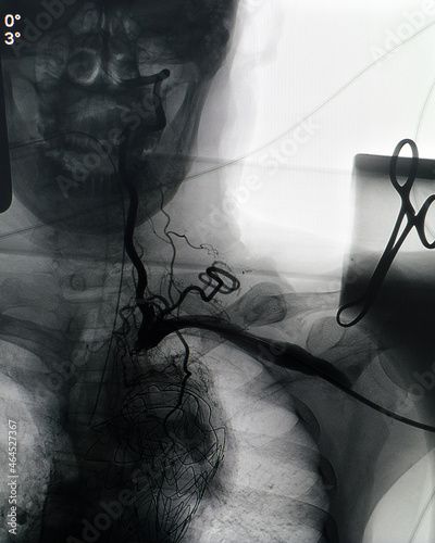 vascular angiogram was performed subclavian artery and common carotid artery photo