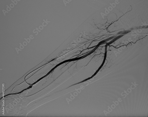 The preoperative evaluation consisted of angiogram of the radial artery. The angiogram showed radial artery stenosis photo