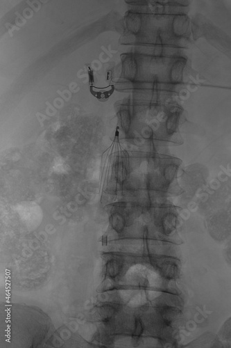 Canvastavla X-ray was perform inferior vena cava (IVC) filter placement, IVC filter for trap