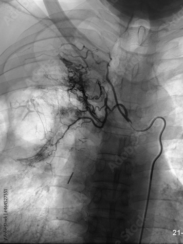 Pulmonary angiography with contrast injected into embolization of right bronchial artery