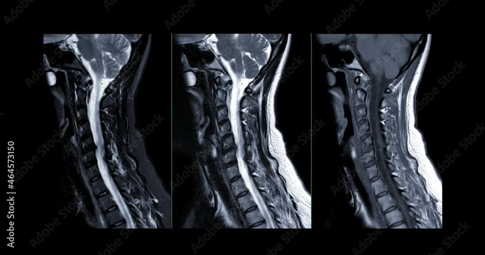MRI C-spine or magnetic resonance image of cervical spine Axial ...