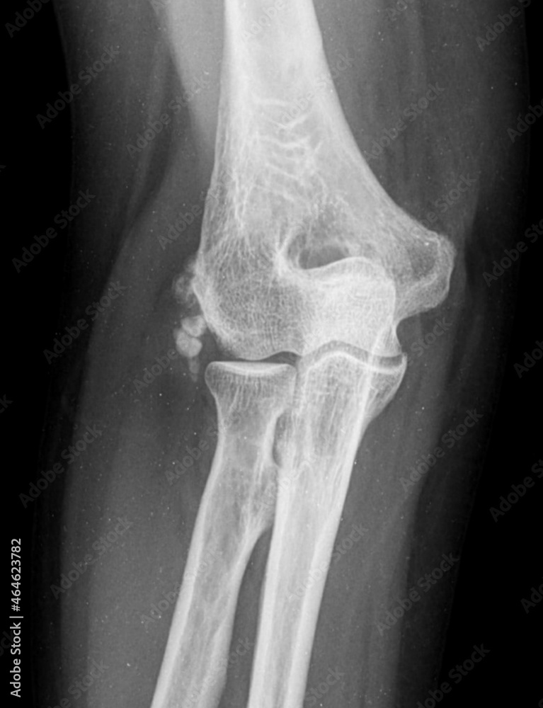 x ray of a Synovial chondromatosis elbow Stock Photo Adobe Stock