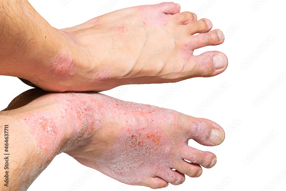 Fototapeta premium Isolated dry skin on foot. Close up of wound and dry skin on human foot. Winter season self-care concept. Atopic dermatitis disorder. 