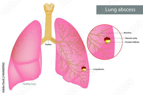 Lung abscess is a type of liquefactive necrosis of the lung tissue. Purulent infiltrate and Necrotic cavity in the lungs. Lungs disease necrotizing pneumonia photo