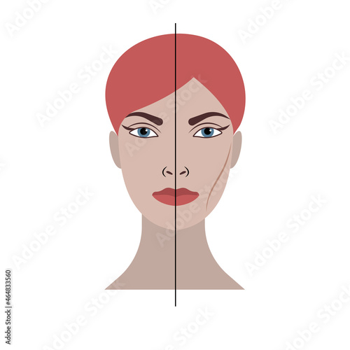 Buccal Fat Removal