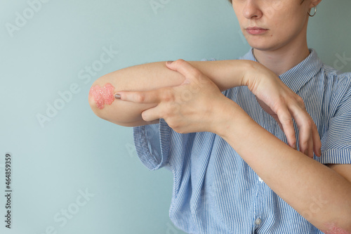 Woman with psoriasis. Health allergy skin care problem, Psoriasis vulgaris. Joints affected by psoriatic arthritis