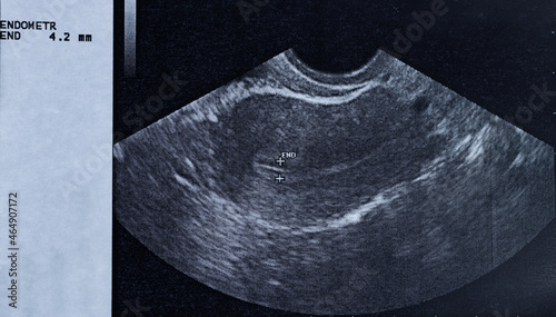 Konstfotografi Ultrasound of a woman's uterus showing the size of the endometrium