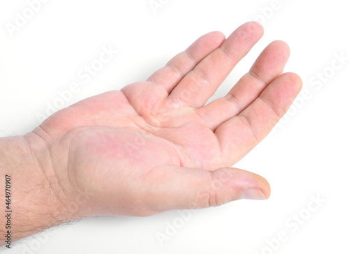 Dupuytren's contracture, also called Dupuytren's disease, Morbus Dupuytren, Viking disease, and Celtic hand. On white background. photo