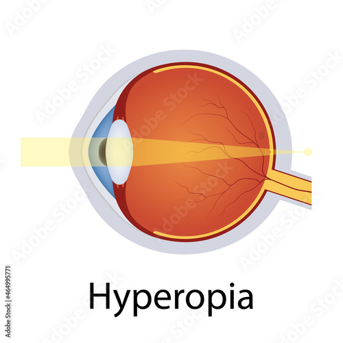 Hyperopia and Vision Disorders Illustration. Eyes Defect Concept. Detailed Anatomy Eyeball with Hyperopia Defect. Isolated Vector