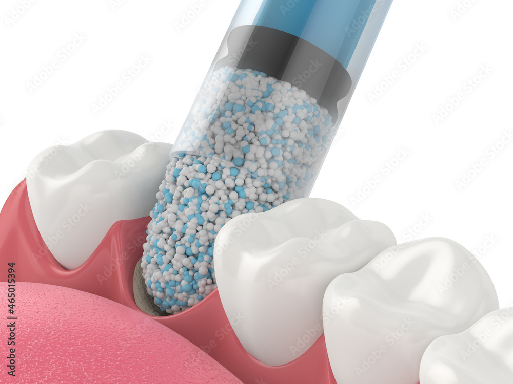 3D render of dental bone grafting with dental bone biomaterial application - obrazy, fototapety, plakaty 