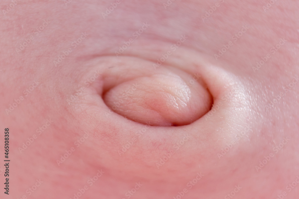 Healing navel of a newborn baby after a dropped umbilical cord Healing navel of a newborn baby after a dropped umbilical cord