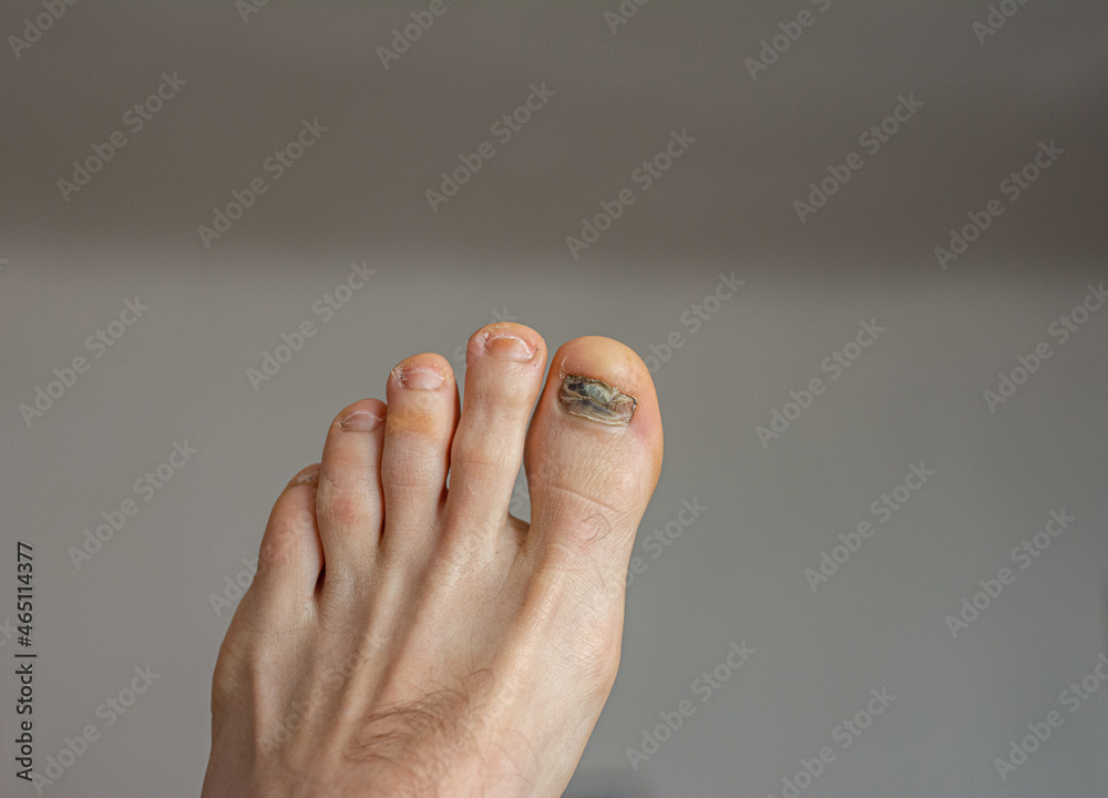 Injury of a blackened chipped toenail in a man treatment and prevention