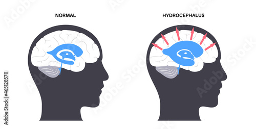 Ventricular system concept photo