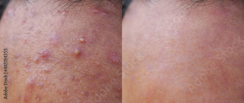 Image before and after acne treatment on the face of young Asian men. Problem skin and beauty concept. 