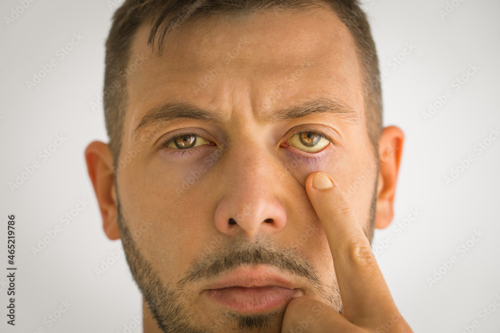 Foto de Sick man with yellow eyes. Liver disease. Problems with liver